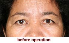 plastic-surgery-blepharoplasty